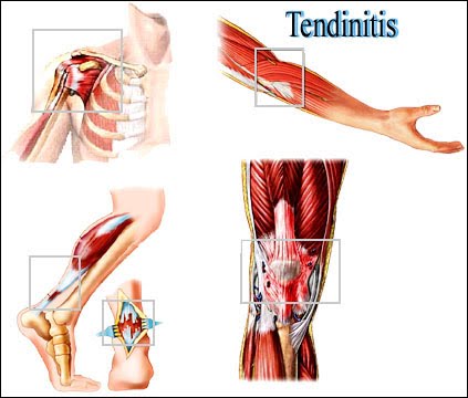 tendinitis fisioterapia